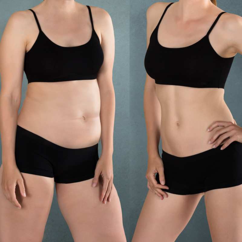 Does Fat Freezing at Home Work? DIY Devices vs Professional Cryolipolysis 2 before and after Cryolipolysis Stotfold