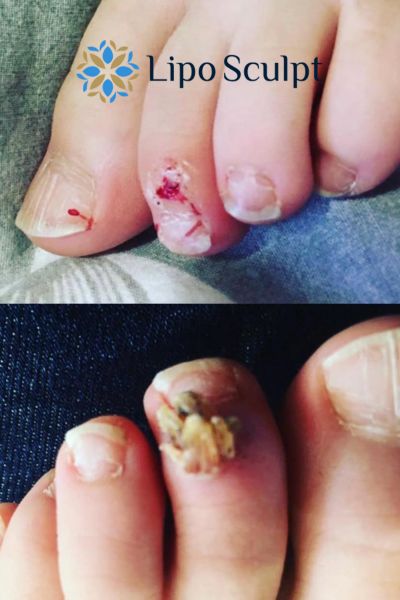 Wart removal customer results from Lipo Sculpt Stotfold